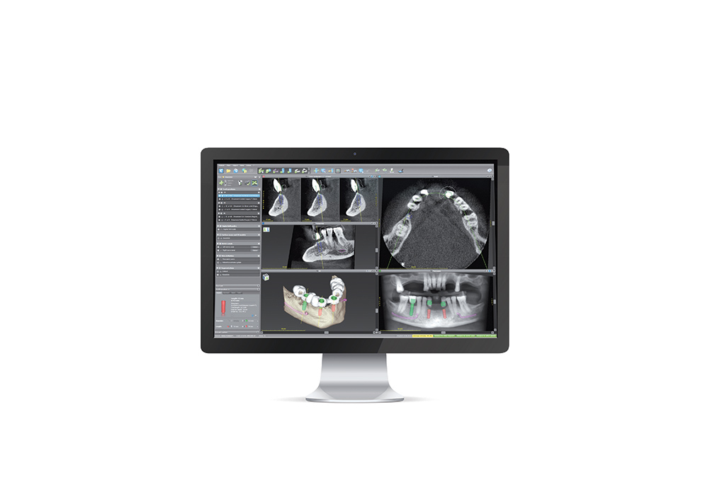 インプラント：ガイド埋入