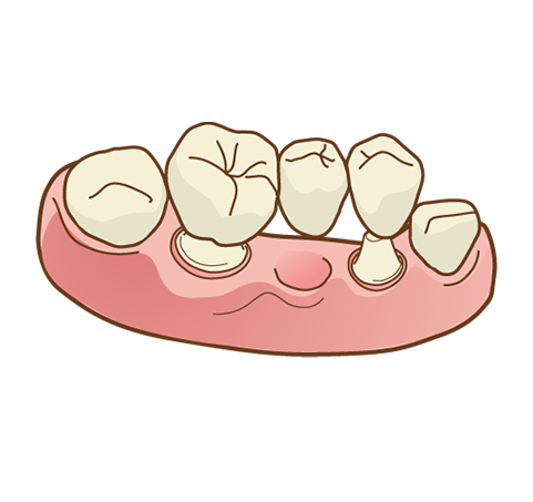ブリッジ、義歯