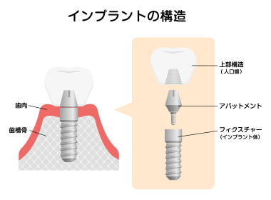 インプラント