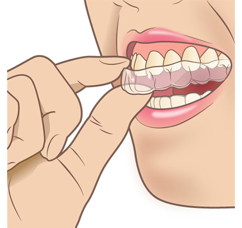 マウスピース矯正